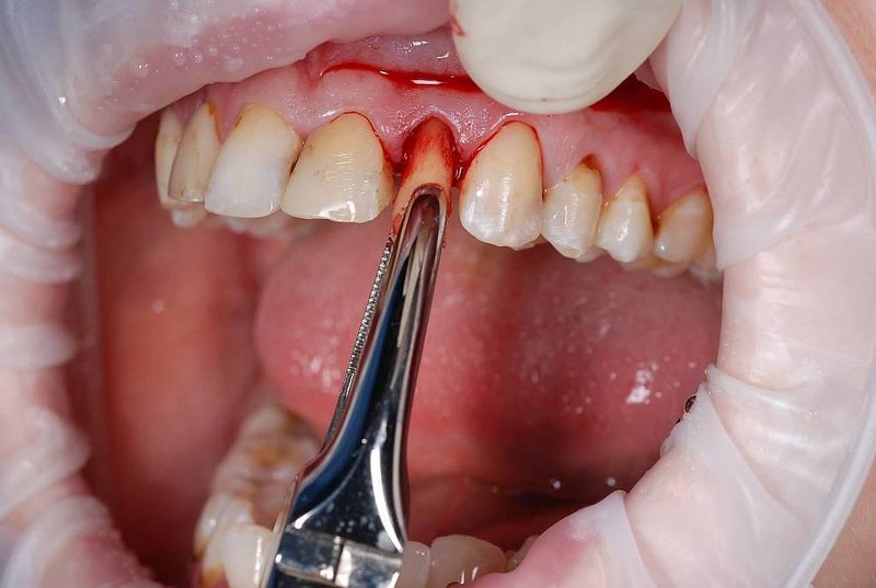 Тянут зуб щипцами